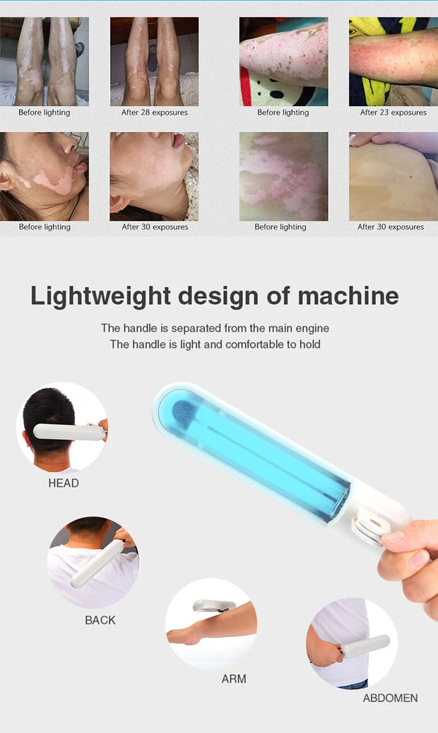 UVB Phototherapy Narrow 311nm UV Phototherapy Lamp Uvb Light Therapy Vitiligo For Psoriasis